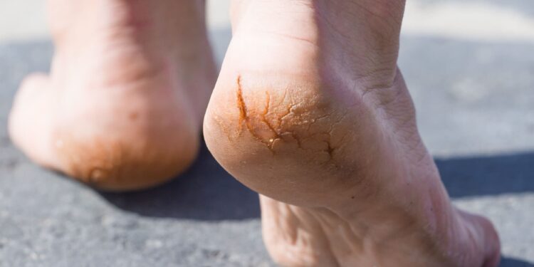 ที่ขัดส้นเท้า ยี่ห้อไหนดี - 1